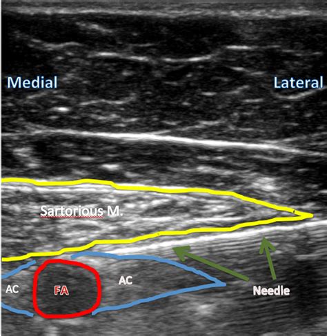 PNBschool.com/ Learn ultrasound guided adductor canal blocks