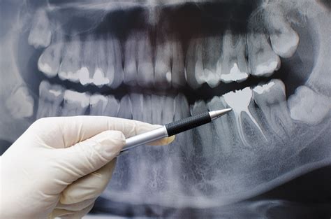 Dentist showing something on dental x-ray image | Sunninghill Dental