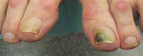 A Day in the Life of a Nail Expert: Pseudomonas Nail Infections - Health - NAILS Magazine