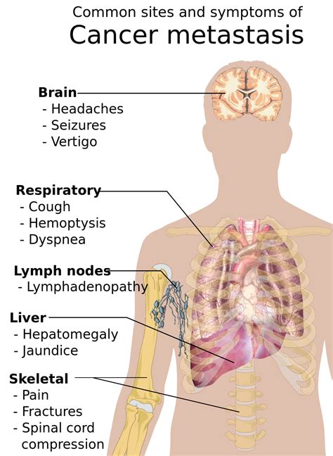 Signs and symptoms of cancer - Wikipedia