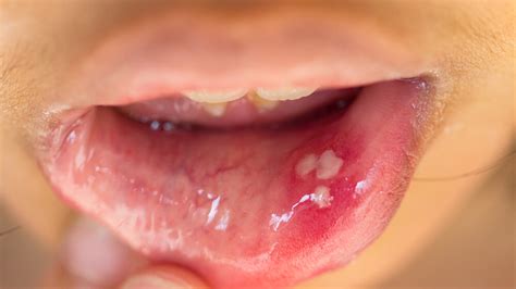 STD In Mouth | Awareness And Preventions Tips