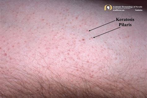 Keratosis Pilaris: It Feels Like Sandpaper... - Academic Dermatology of ...