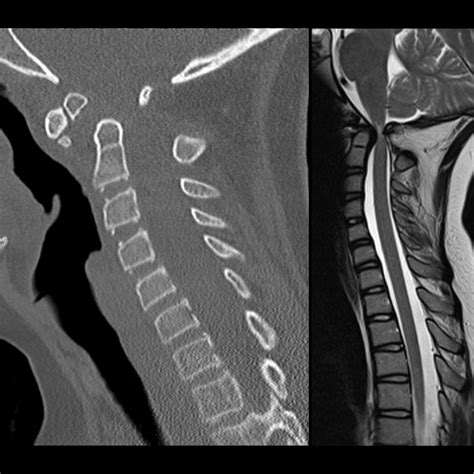 Os Odontoideum | Pediatric Radiology Reference Article | Pediatric Imaging | @pedsimaging