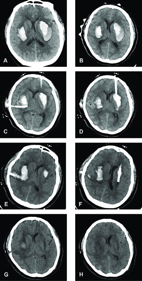 Non-contrast head CT showing bilateral basal ganglia hemorrhages. (A)... | Download Scientific ...