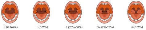 The Brodsky grading scale of tonsil size. Grade 0 (tonsils in the ...