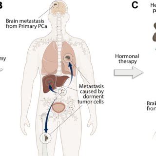 Impact of therapeutic management on prostate cancer brain metastasis ...