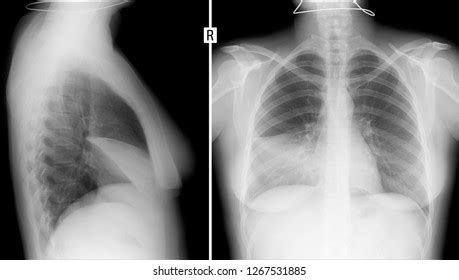 Xray Lungs Pleurisy Right 스톡 사진 1267531885 | Shutterstock