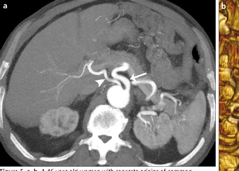 Figure 5 from CT angiography of the celiac trunk : anatomy , variants and pathologic findings ...