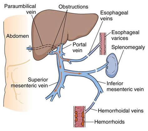 Portal Hypertension: Increased pressure in the portal vein caused by an ...