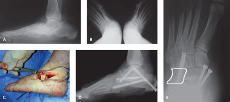 Triple Arthrodesis | Musculoskeletal Key