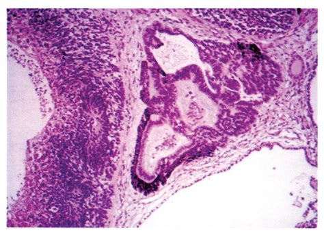 Teratoma Histology