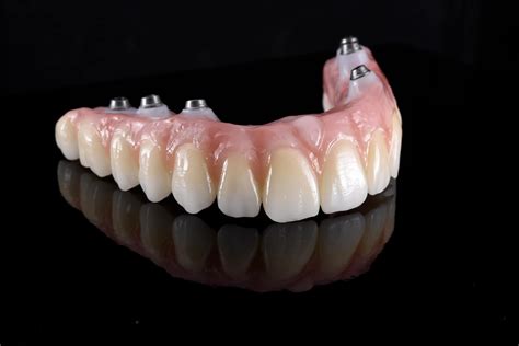 Dental Implant Hybrid Restorations - Burbank Dental Lab