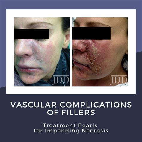 Vascular Complications of Fillers: Treatment Pearls for Impending Necrosis - Next Steps in ...