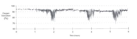 What Do These Overnight Pulse Oximetry Test Results Suggest? | Consultant360