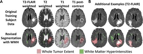 Frontiers | Multi-Disease Segmentation of Gliomas and White Matter Hyperintensities in the BraTS ...