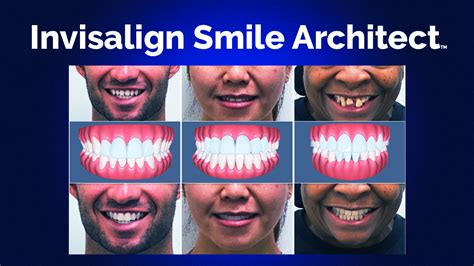 Using Invisalign Smile Architect for Digital Interdisciplinary Care ...