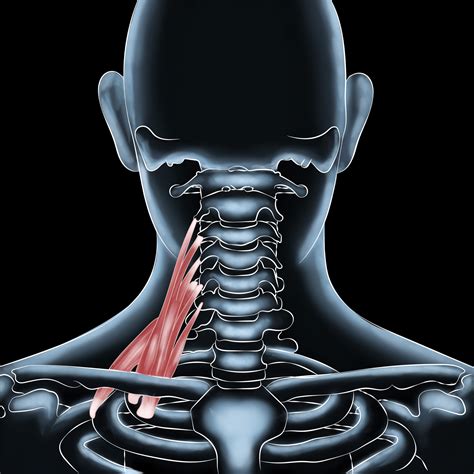 Scalenes Muscle Injuries - Breathing Easy Again