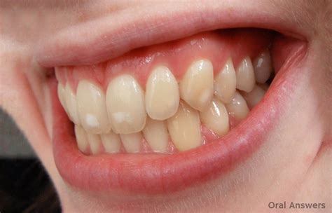 Dental Fluorosis Treatment: How Dental Fluorosis Is Treated | Oral Answers