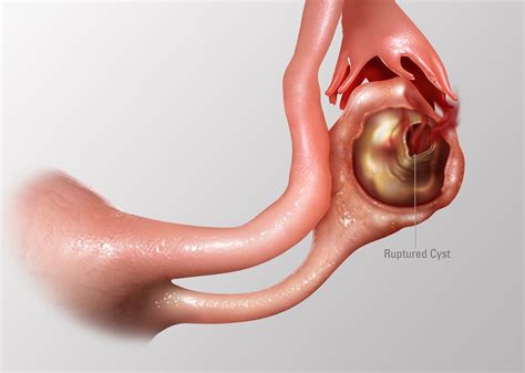 Ovarian cysts development cause terrible complications