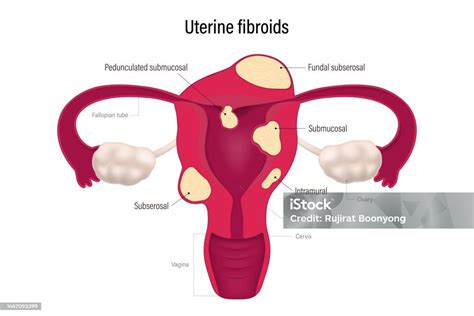 Uterine Fibroid Locations Pedunculated Submucosal Fundal Subserosal ...