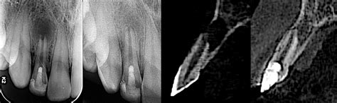 Regenerative endodontics Archives - Style Italiano Endodontics