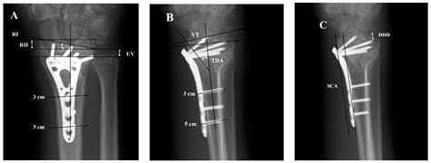 JCM | Free Full-Text | Radiographic Analysis in Extra-Articular and ...