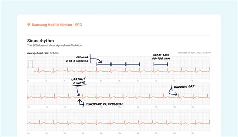 Junctional Rhythm Vs. Sinus Rhythm on Your Watch ECG | Qaly