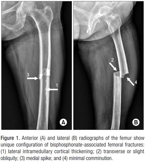 metabo's kuwento: Atypical Femoral Fractures