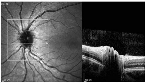 JCM | Free Full-Text | Optic Nerve Drusen Evaluation: A Comparison ...