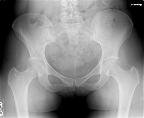 Pelvic Anatomy Xray / Pelvic Xray Stock Photo Alamy - Each hemi pelvis bone comprises 3 bones ...