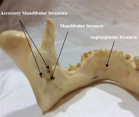 Accessory mandibular, supraspinous and mandibular foramen. | Download Scientific Diagram