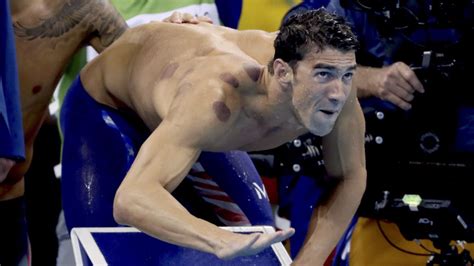 Michael Phelps' Red Circles From Cupping Therapy