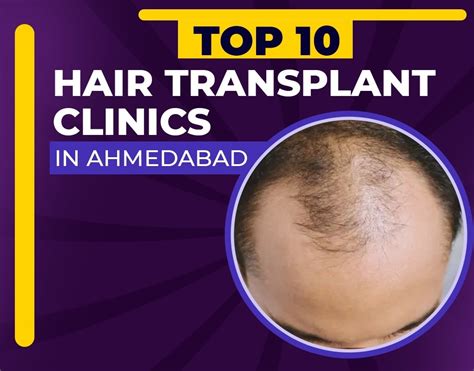 Top 10 Hair Transplant Clinic In Ahmedabad 2024