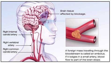 Ischemic stroke illustration (American Stroke Association 2015). | Download Scientific Diagram