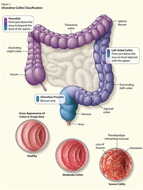 The Patient with Newly Diagnosed Ulcerative Colitis | healthPlexus.net