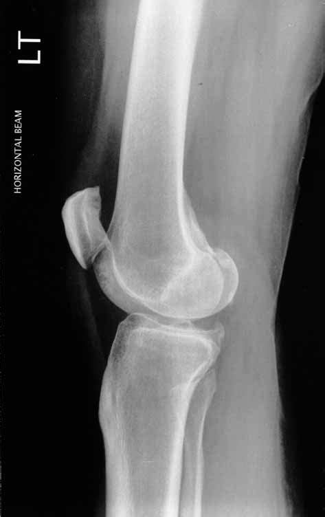 Lateral radiograph of the knee showing superior dislocation of the... | Download Scientific Diagram