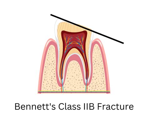 Bennett's Classification of Tooth Fracture - Dental Dictionary