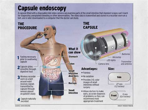 Video Capsule Endoscopy Procedure Cape Town | Small Bowel Examination