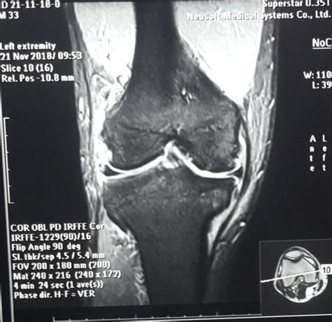 MRI of the knee (Coronal view). Shows multi-ligament knee injury.... | Download Scientific Diagram