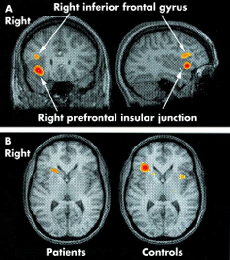 Concussion Brain Compared To Normal