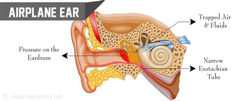 Airplane Ear | Ear Barotrauma – Causes, Symptoms, Diagnosis, Treatment and Prevention