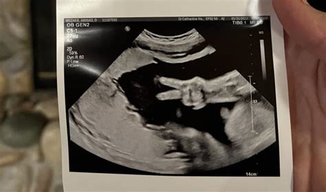 Fetus's gesture in ultrasound photo catches parents by surprise