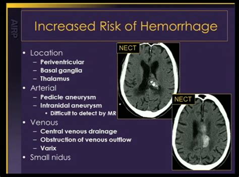 rsna: vascular malformation, brain