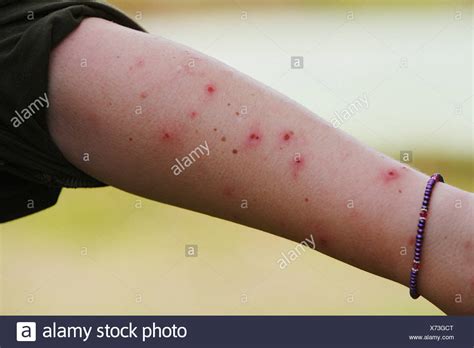 Mosquito Bites High Resolution Stock Photography and Images - Alamy