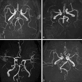 Typical examples of Fazekas grade 1, 2 and 3 white matter... | Download ...