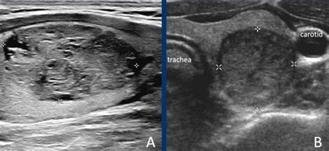 Ti Rads Ultrasound