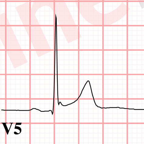 J point notching ECG