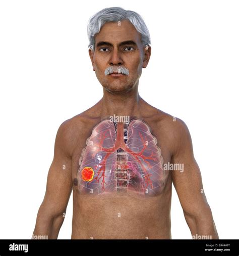 Lungs affected by lung cancer, illustration Stock Photo - Alamy