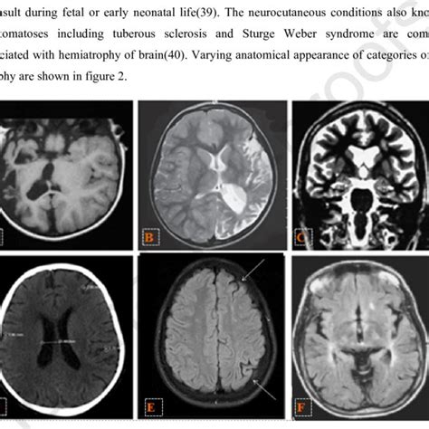 TYPES OF BRAIN ATROPHY. | Download Scientific Diagram