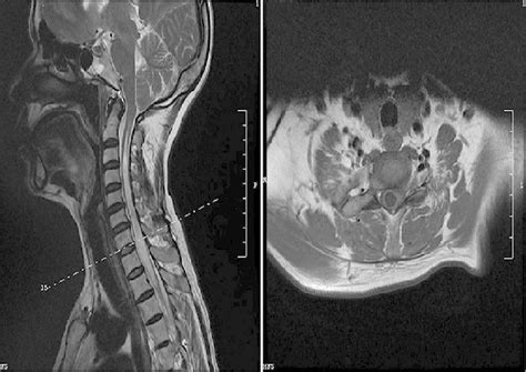 MRI showing cervical syrinx | Download Scientific Diagram